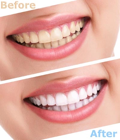 before and after teeth whitening services at Southview Dental Care